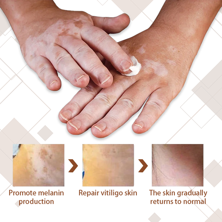 Ceoerty™ Advanced Squalene Vitiligo Treatment Cream